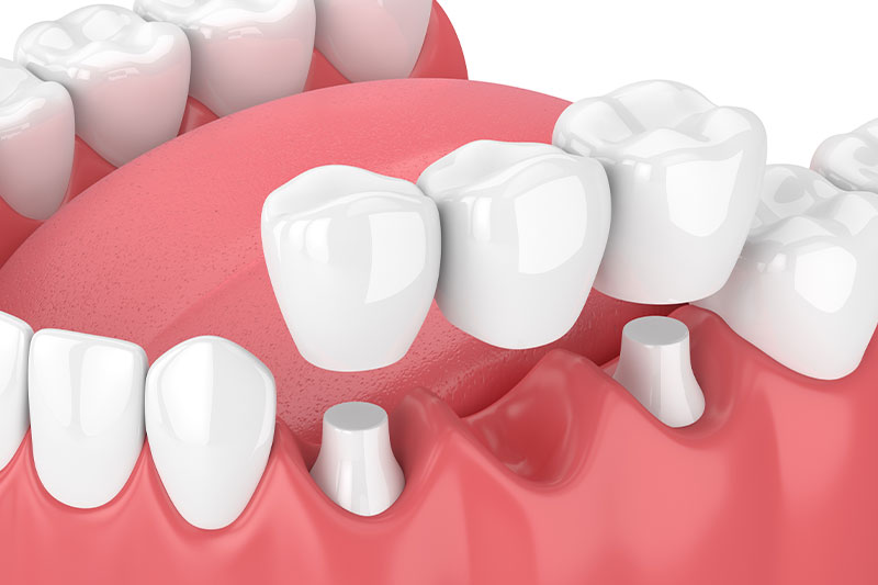 Fixed Dental Bridges in San Ramon