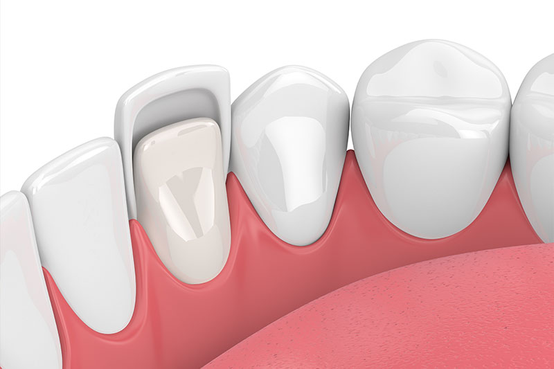 Dental Veneers in San Ramon