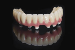 Hybrid Implant Denture