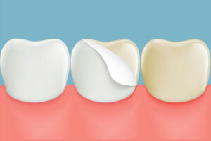 lumineer veneers illustration