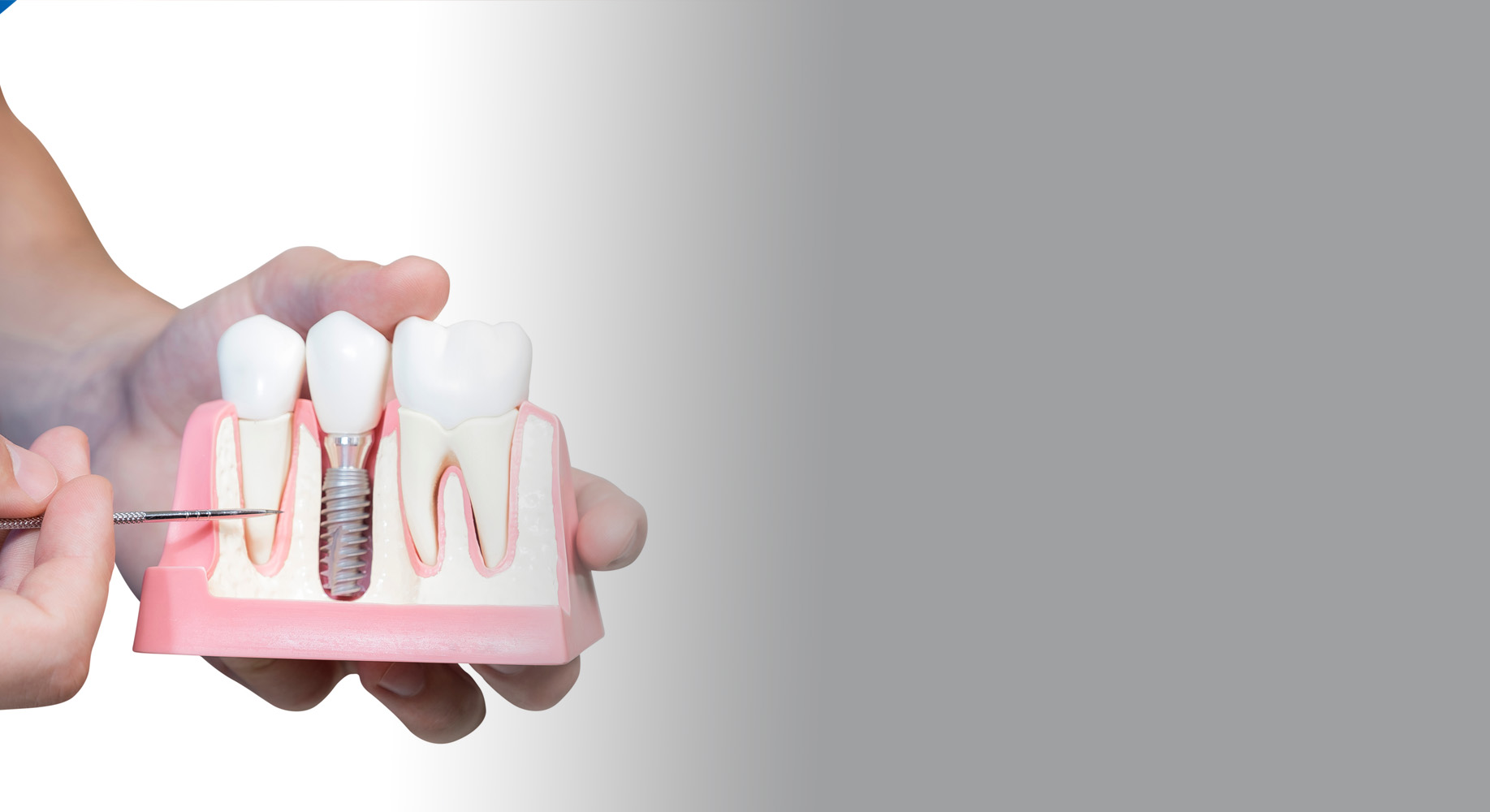 Reclaim your smile and confidence with dental implants!