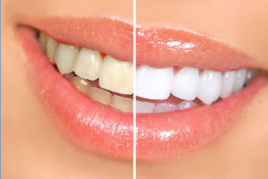 Before and after teeth whitening.
