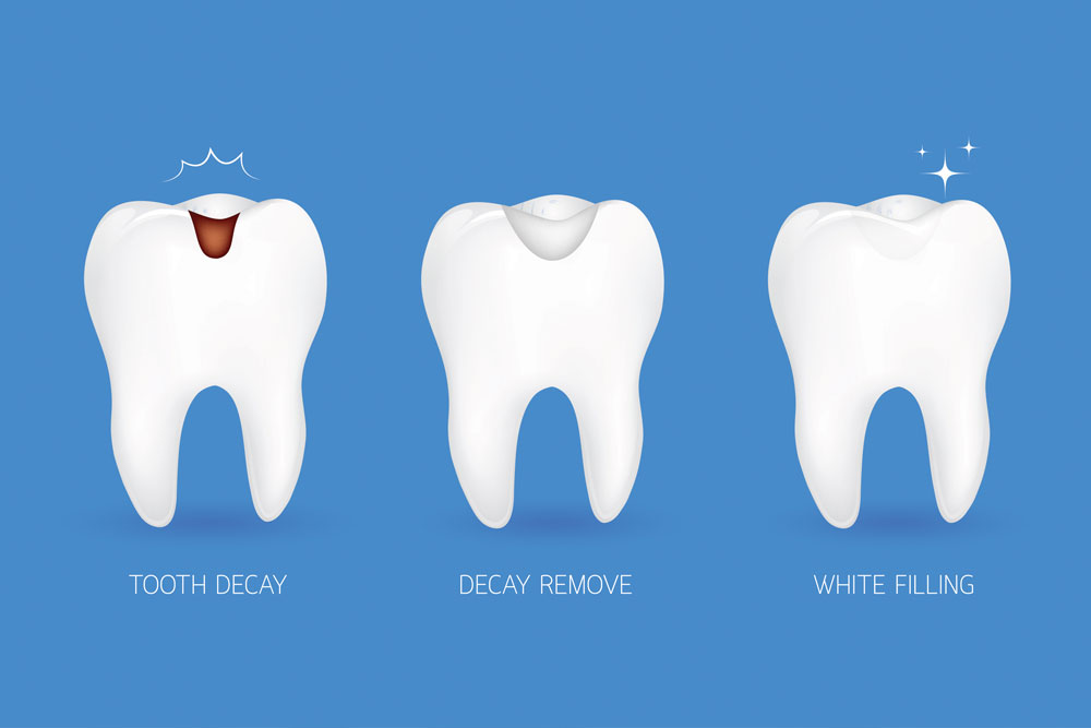An illustration of the dental filling process.